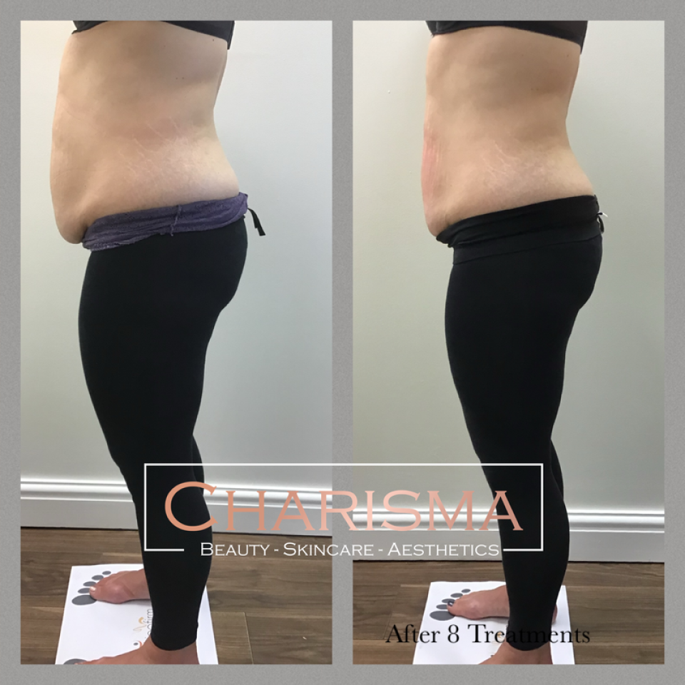 Non Surgical Fat Loss Treatment