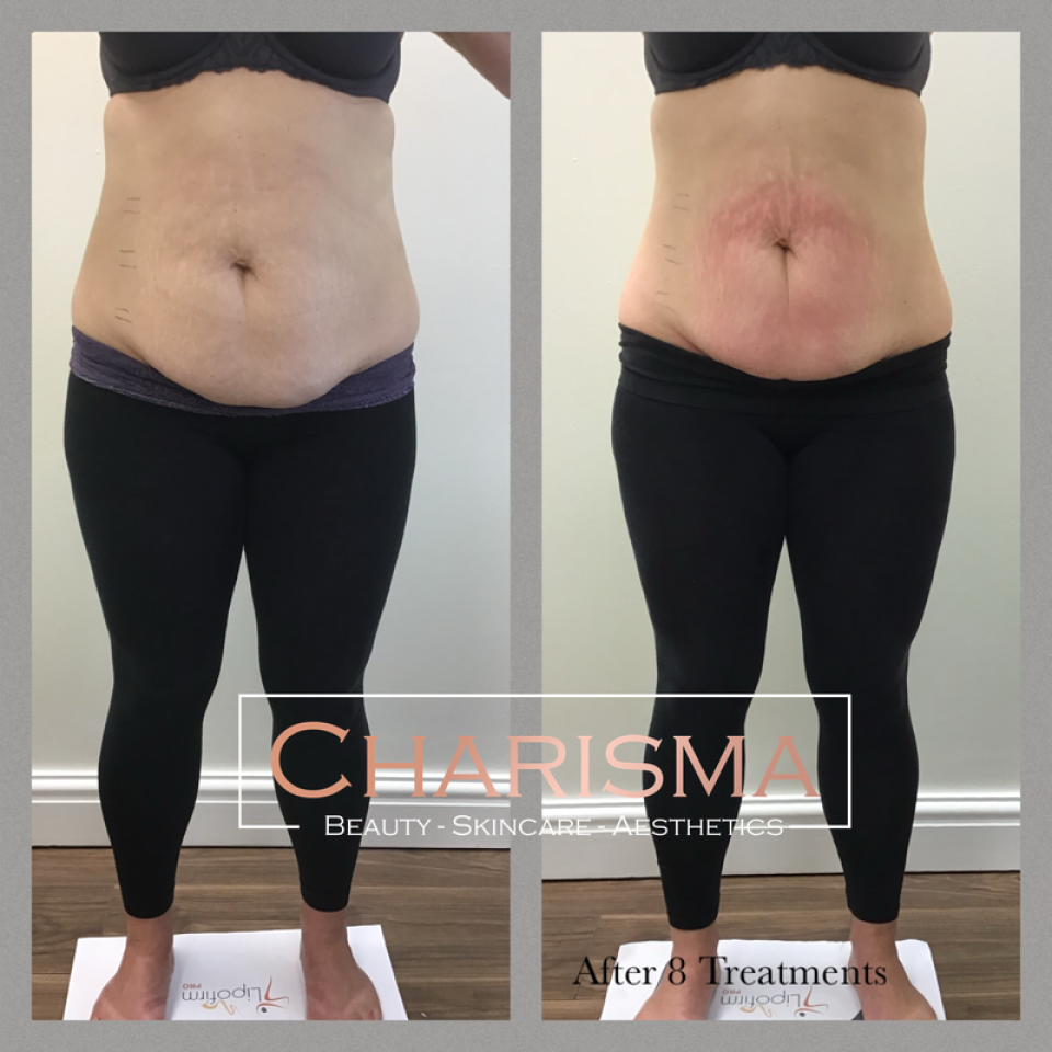 Non Surgical Fat Loss Treatment